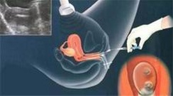 【揭秘】三代试管婴儿成功率大揭秘：如何提高你的，几率